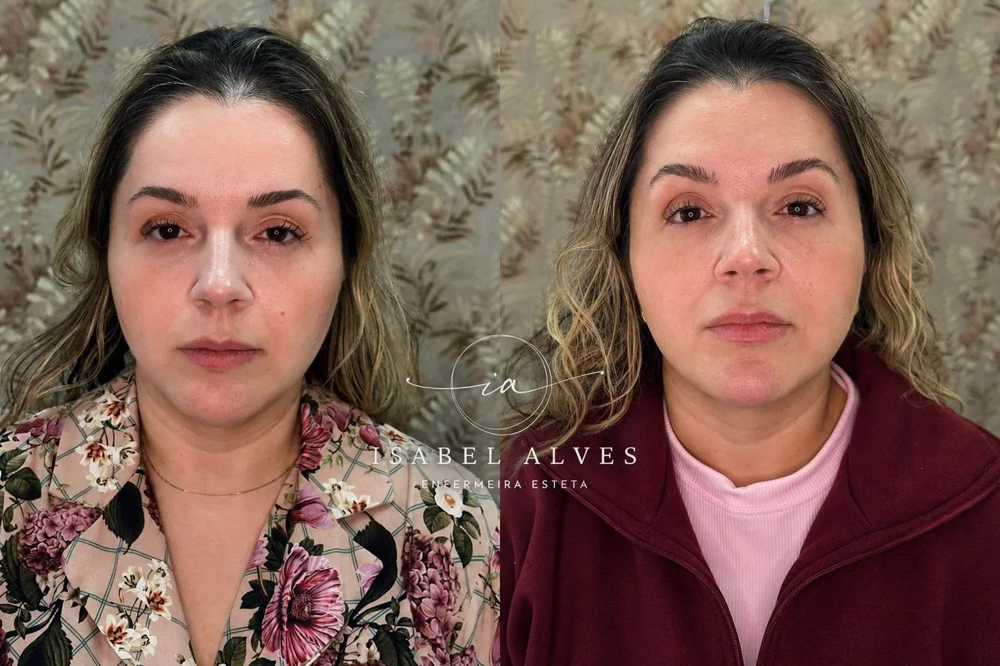 Paciente antes e depois da harmonização facial completa, com os contornos do rosto mais definidos.