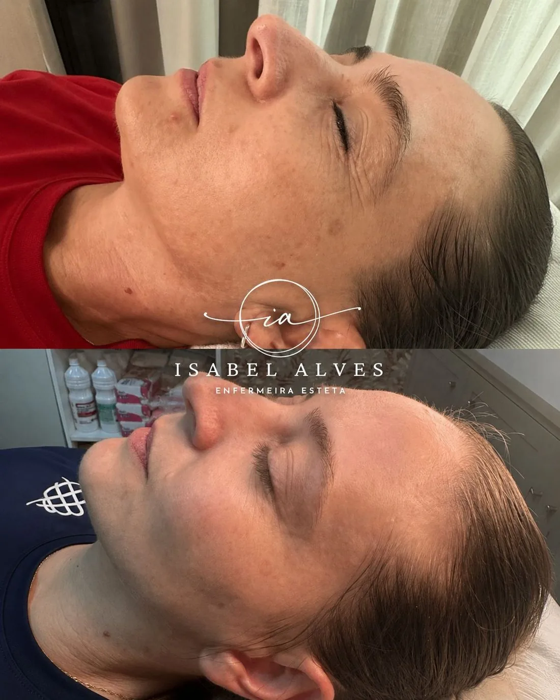 Rosto da paciente antes e depois do tratamento de melasma, com as manchas mais claras e o tom da pele mais uniforme.