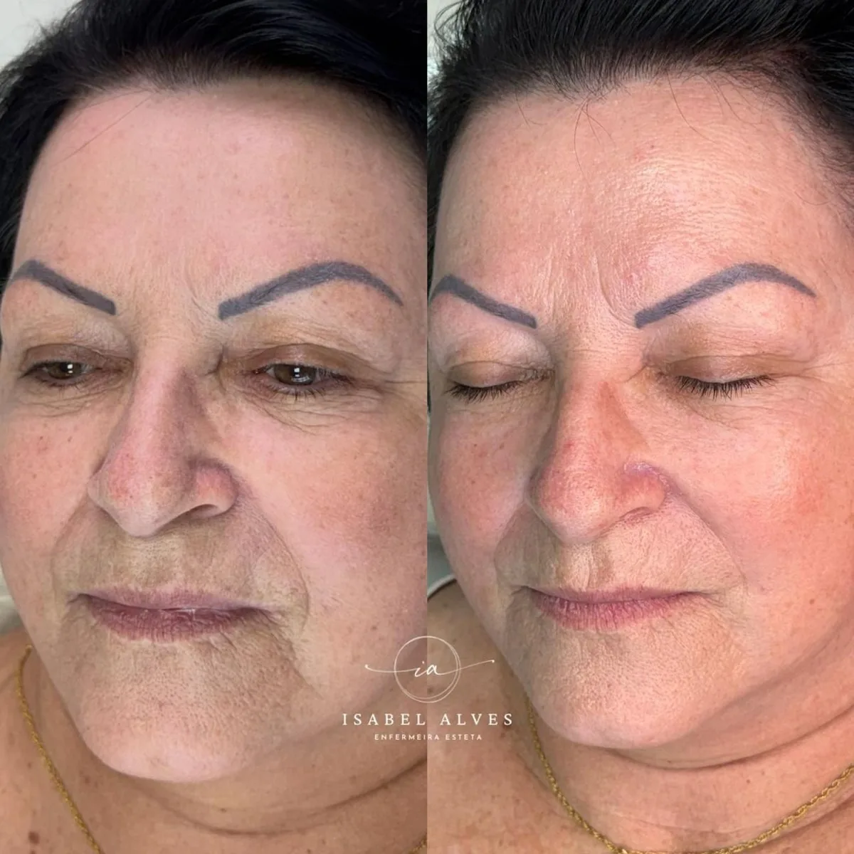Paciente antes e depois do tratamento da área dos olhos, com a pele da pálpebra e do contorno mais lisa e uniforme.